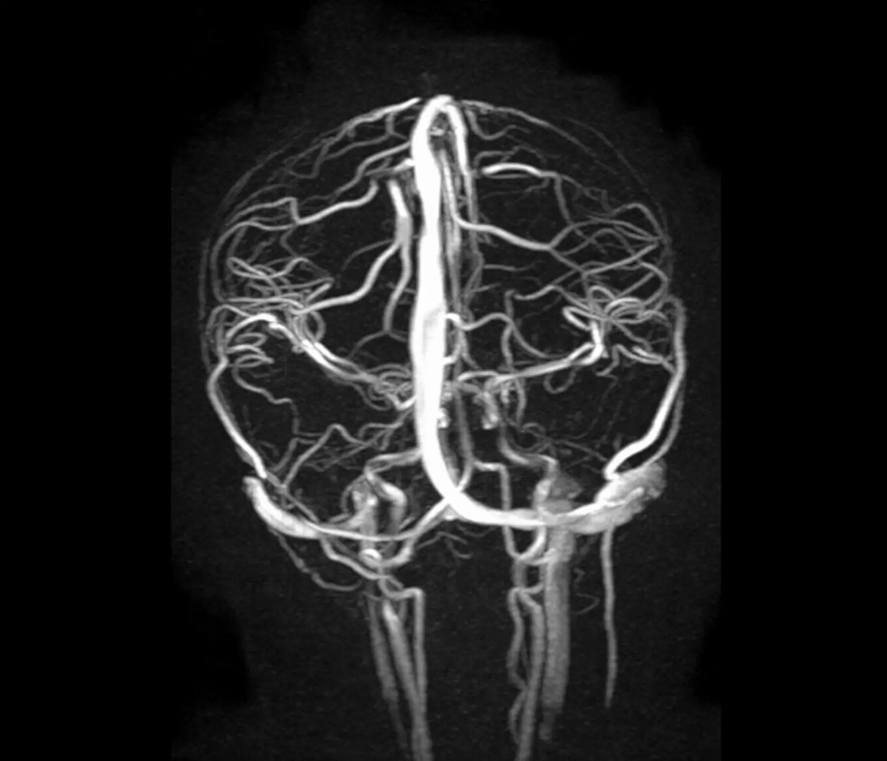 Angiografia rezonansu magnetycznego (angio MR)